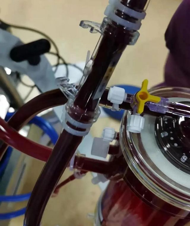 首例！救命的硬核武器—ECMO技术在西南医大附院成功开展(图5)