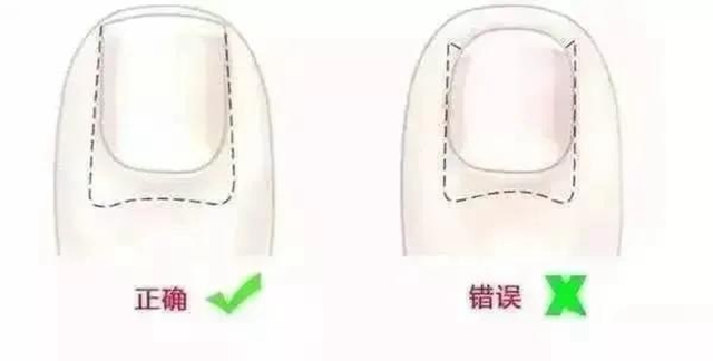 【扩散】脚指甲剪太短！代价可不只是痛……(图7)