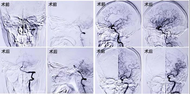七旬婆婆突发脑梗死，深夜抢救1小时完全恢复！(图5)