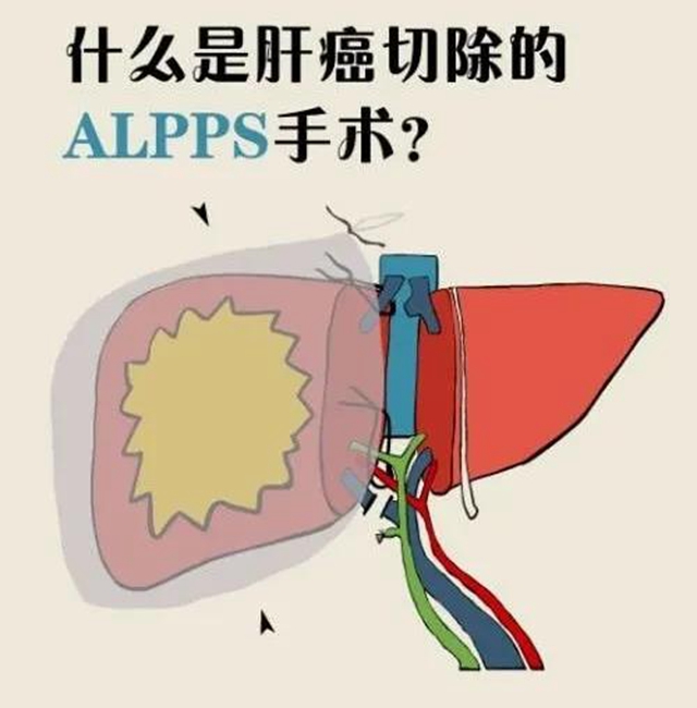 【扩散】肝癌中晚期患者,可以根治啦?(图4) 【扩散】肝癌中晚期患者,可以根治啦?(图4)
