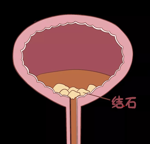 泸州：87岁大爷身体里掏出3斤石头(图4)