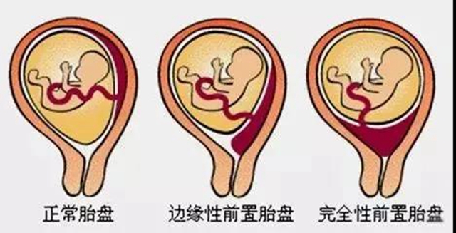 【凶险】胎盘完全堵住宫口，二胎妈妈差点送命？(图3)