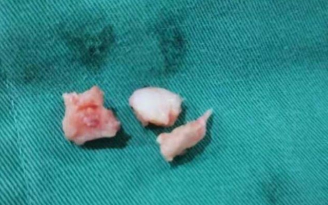 合江初二女生在校被罚150个下蹲致残，医院出具证明：孩子已抑郁(图4)