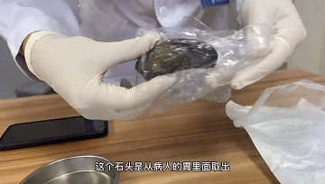 泸州大爷吃柿子吃出超大结石，近期还有多人中招！(图3)