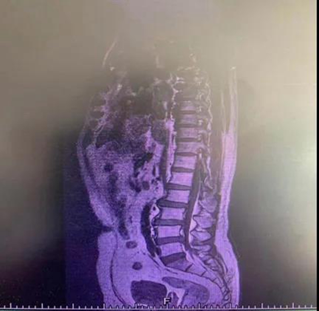 【关注】男子腰痛，医生取出21颗“骨头渣渣”！(图3)