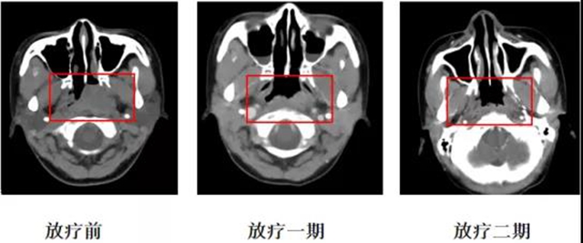 所有的肿瘤患者都需要放疗吗？(图6)