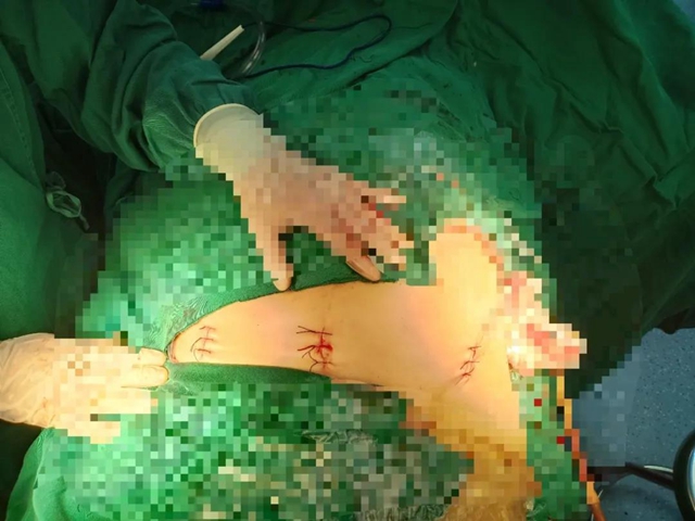 【技术】嬢嬢不慎骨盆骨折,INFIX微创手术解难题!(图5) 【技术】嬢嬢不慎骨盆骨折,INFIX微创手术解难题!(图5)