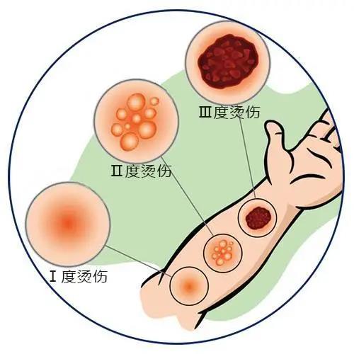 【突发】燃油起火！泸州男子多处被烧伤！(图6)
