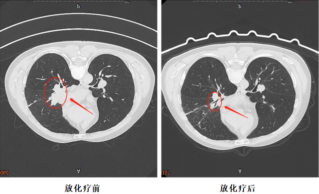 【警惕】肺结节恶化成癌!竟……(图1) 11.jpg