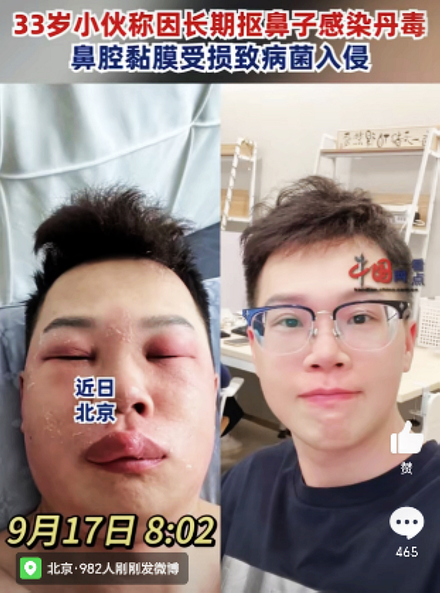 【围观】感染丹毒，33岁小伙面目全非!这个坏习惯你都有……